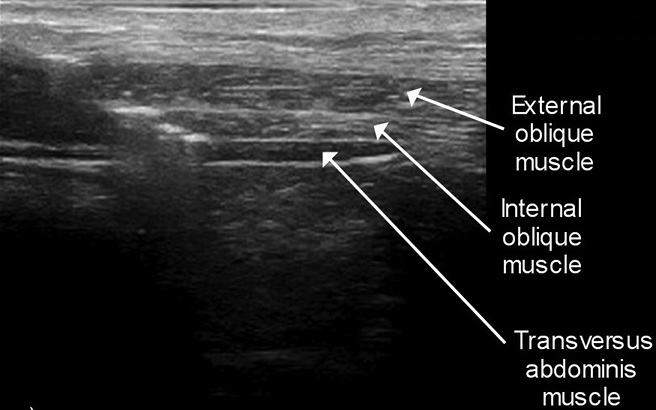 Ultrasound anatomy of the anterior abdominal wall