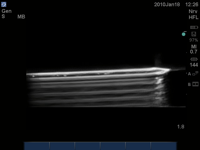 Ultrasound Needle