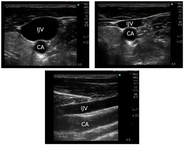 curvilinear probe ultrasound slide