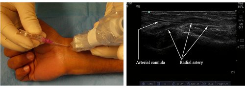 Real-time method for radial artery catheterization.