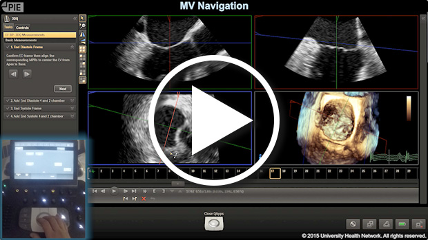 Philips Epiq 7 - MPR Mitral Valve