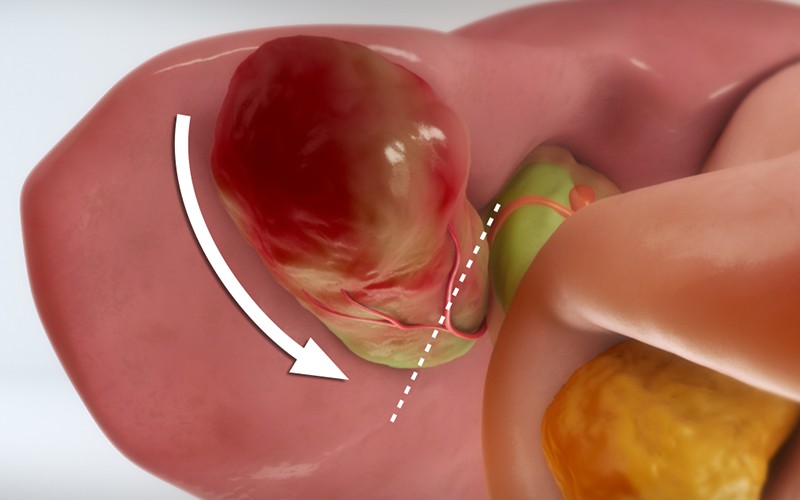 Standard laparoscopic cholecystectomy - TVASurg - The Toronto Video
