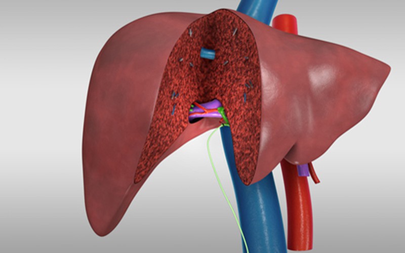 Liver transplant: Living donor right lobe (recipient procedure