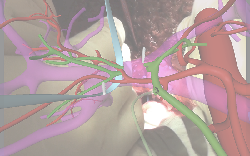 Publication in Journal of Visualized Surgery Publication in Journal of Visualized Surgery