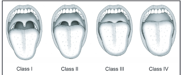 Mallampati score