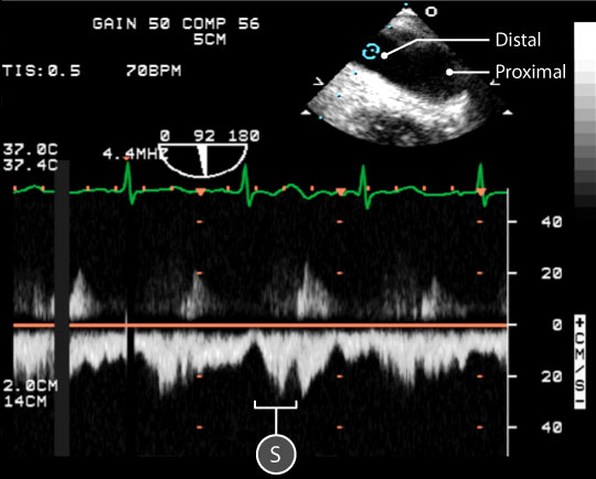 pulse wave spectral doppler of descending aorta