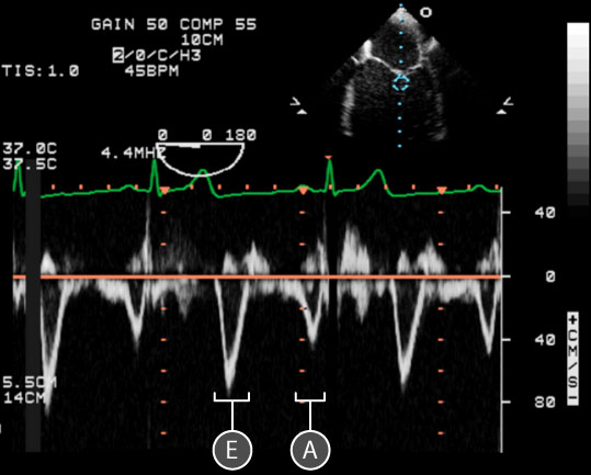 pulse wave spectral doppler of Mitral Valve